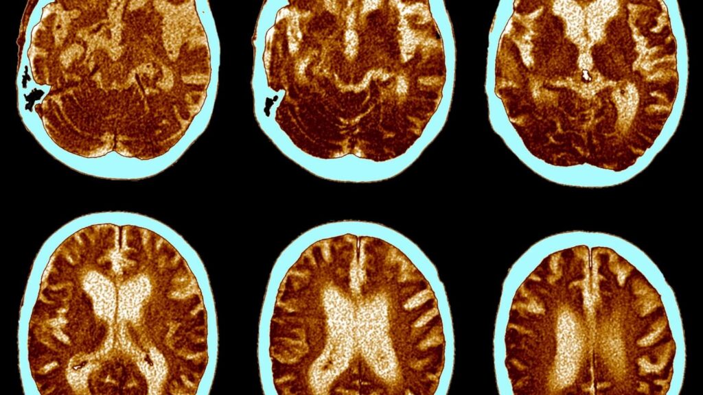 Alzheimer brain scans